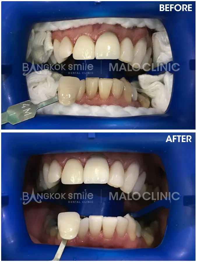 29267 teeth whitening procedure