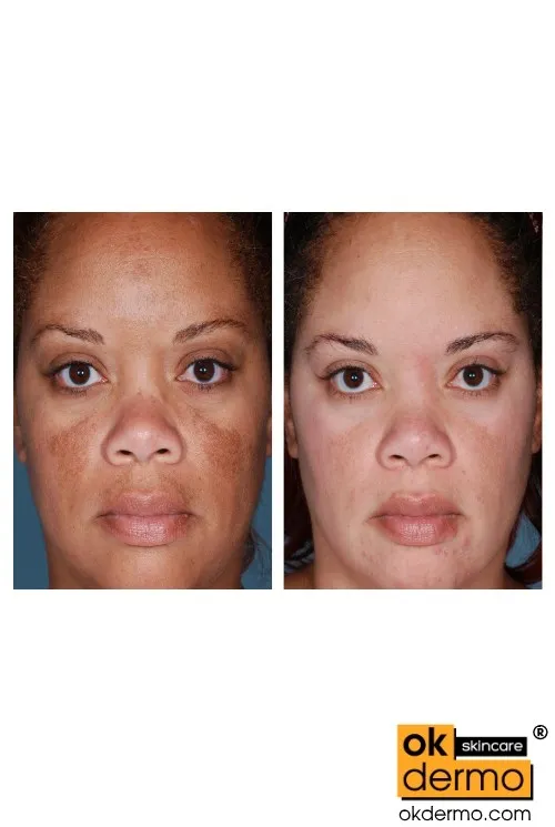 29269 hydroquinone before after
