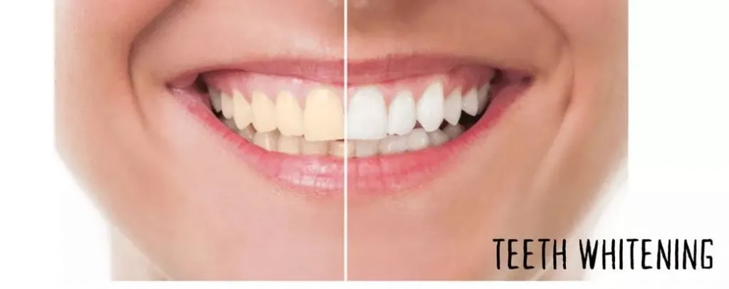 29272 teeth whitening guide image6