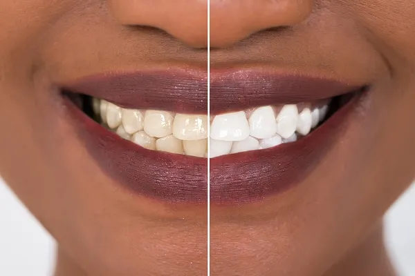 /img/29272-teeth-whitening-guide-image7.webp