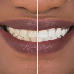 /img/29272-teeth-whitening-guide-image7.webp