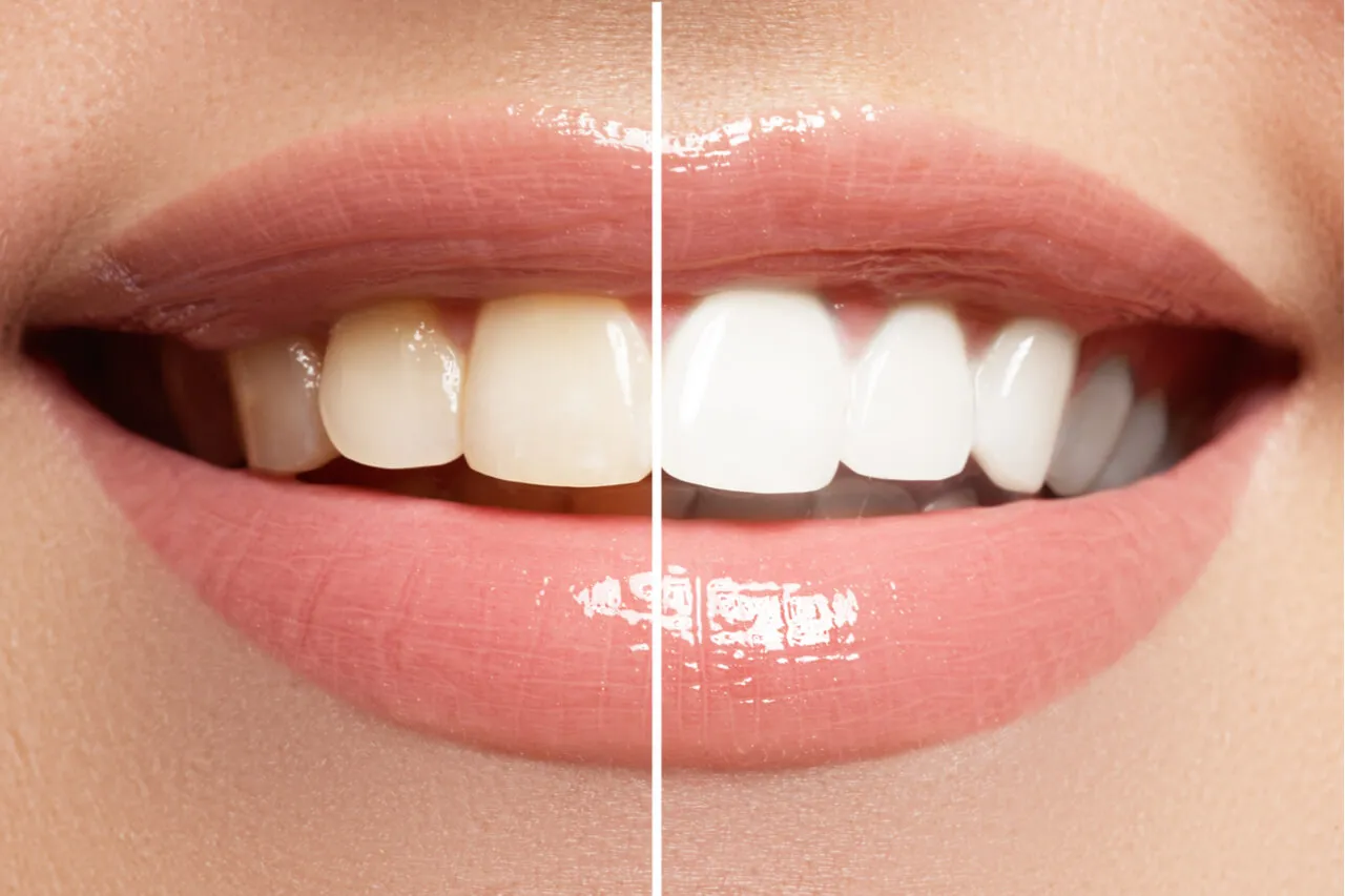 29273 sensitivity to whitening agents