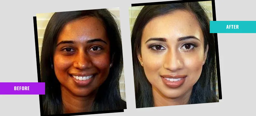 29277 laser whitening face before after