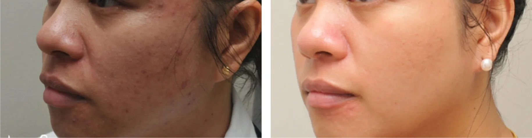 29277 laser whitening face candidate