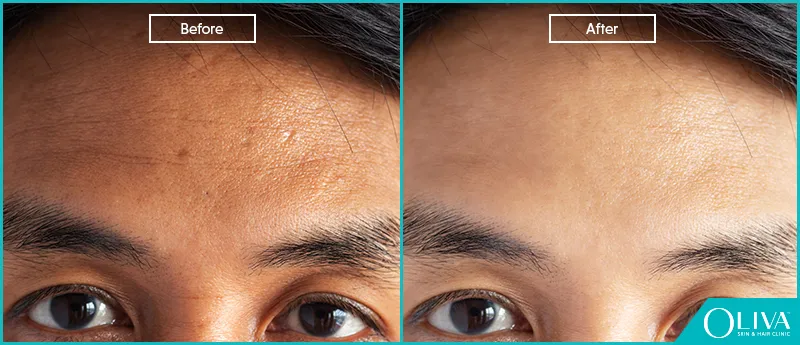 29277 laser whitening face dark spots