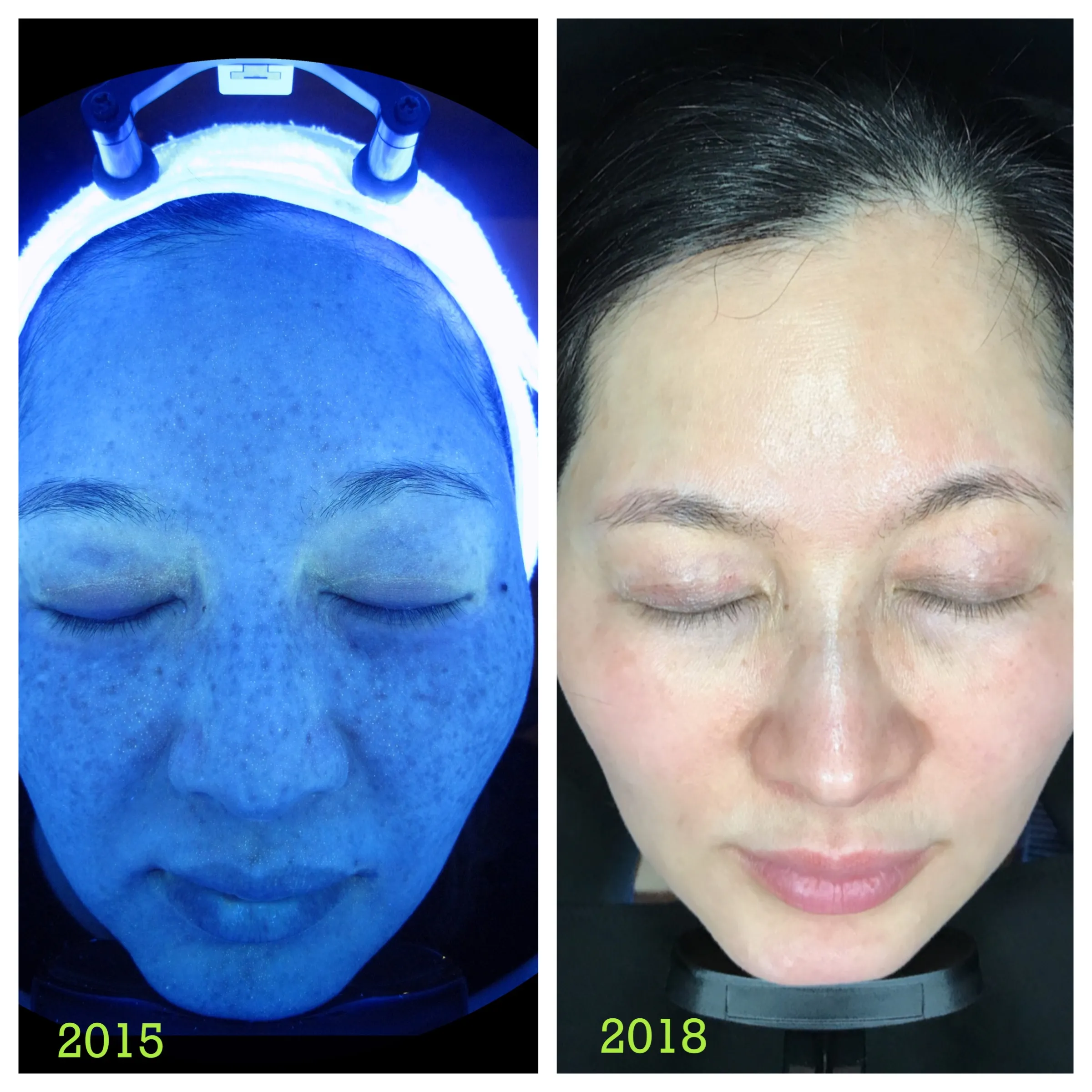 29277 laser whitening face procedure