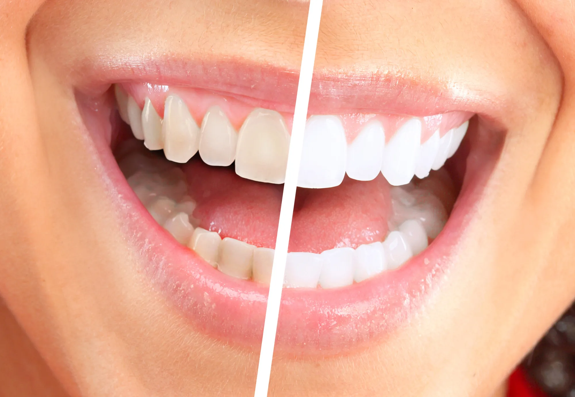 29281 at home teeth whitening kits