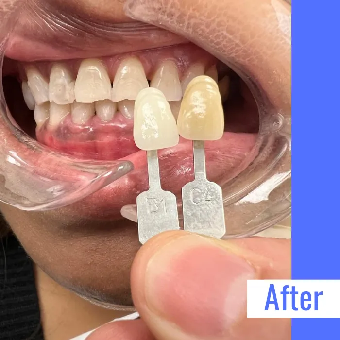 29281 oral hygiene teeth whitening