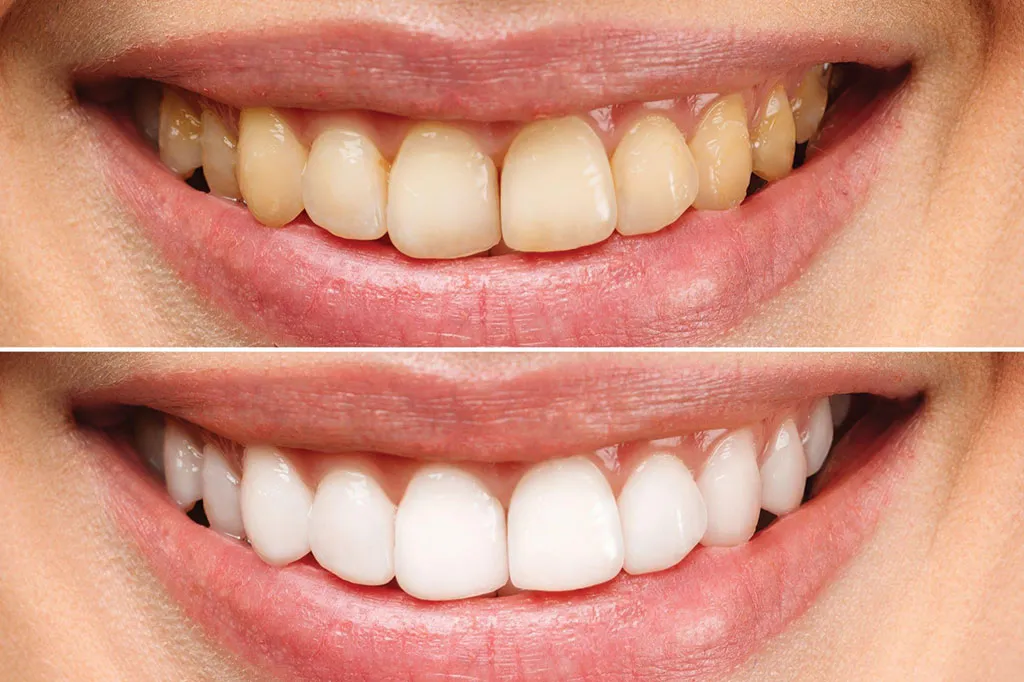 29281 professional teeth whitening