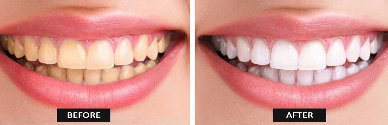 29281 teeth whitening diet