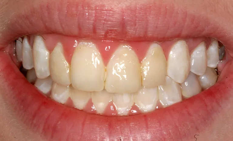 29281 teeth whitening monroe la main
