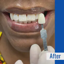 /img/29281-teeth-whitening-results.webp