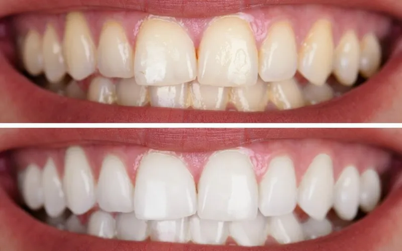 29292 at home teeth whitening essex