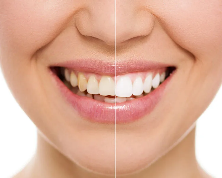 29292 in office teeth whitening essex