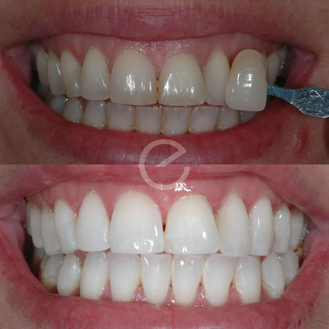 29292 teeth whitening essex before after