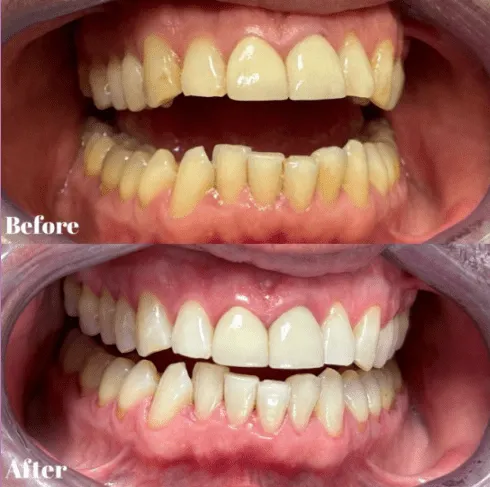 29292 teeth whitening essex clinic