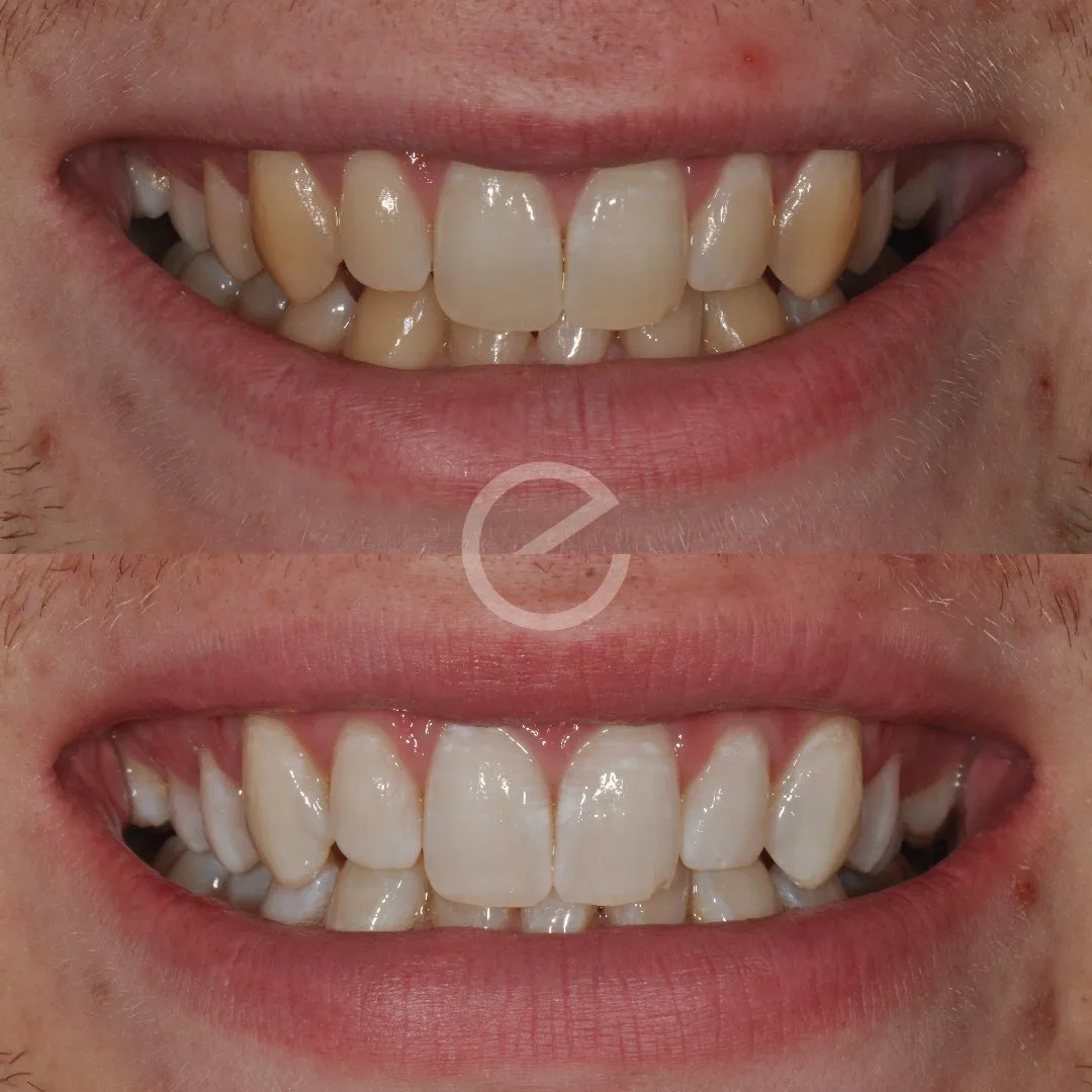29292 teeth whitening essex confidence