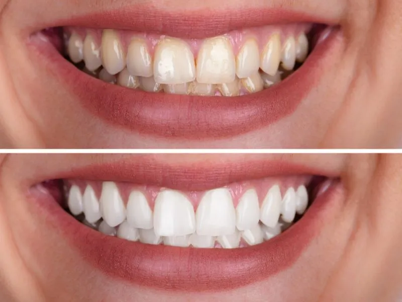29292 teeth whitening essex procedure