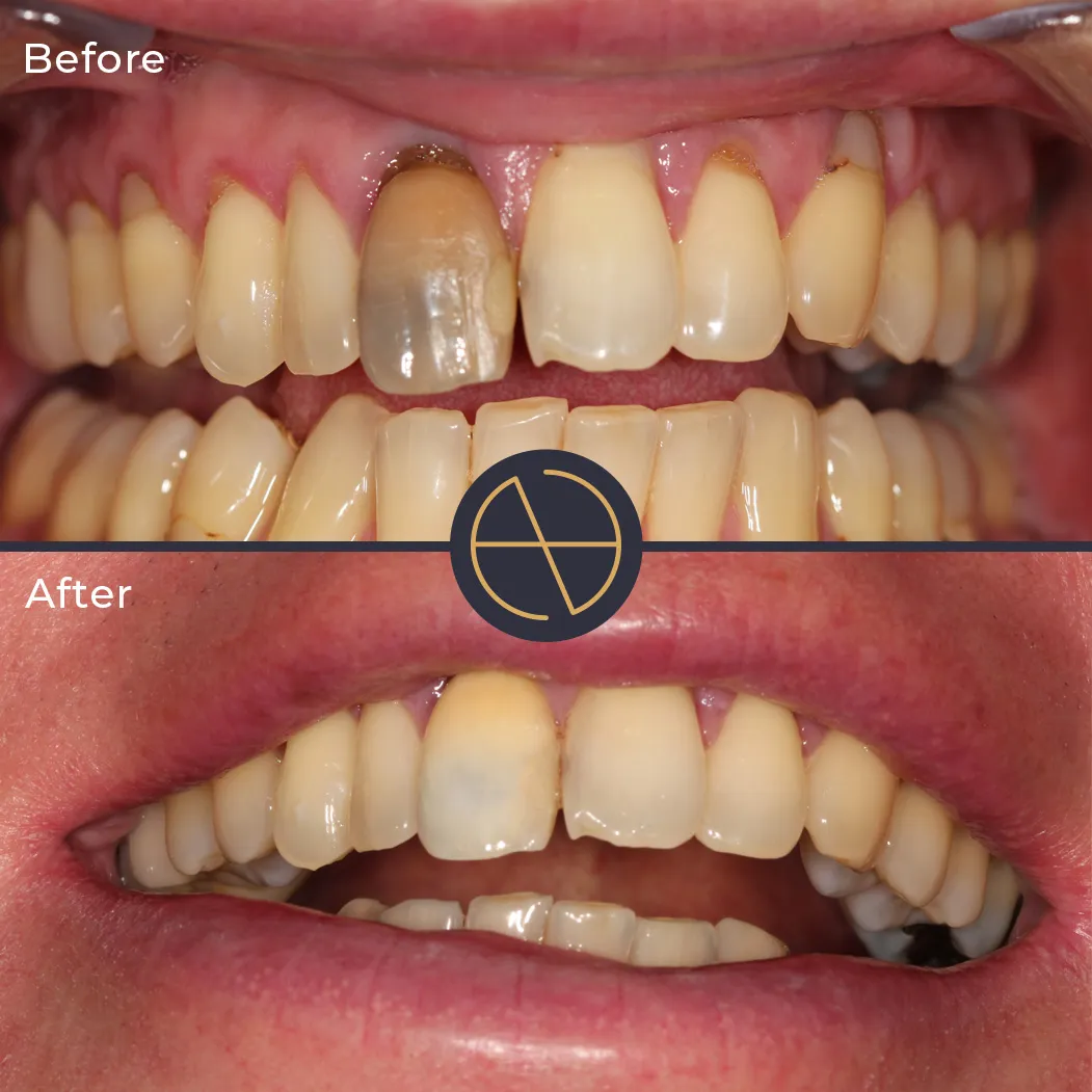 29292 teeth whitening essex types