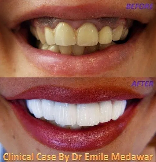 29293 composite veneers