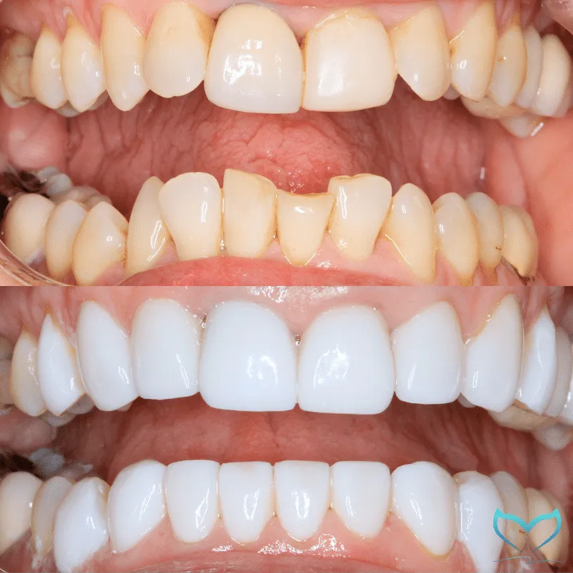 29293 porcelain veneers