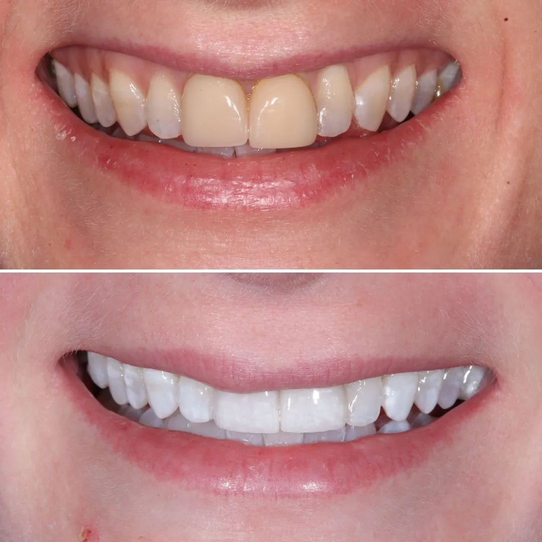 29293 professional whitening