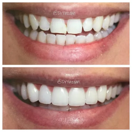 29293 teeth whitening process