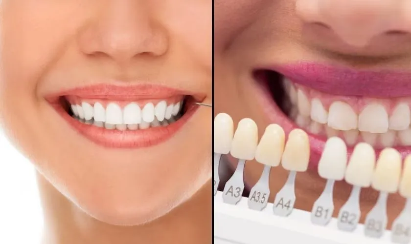 29293 types of veneers