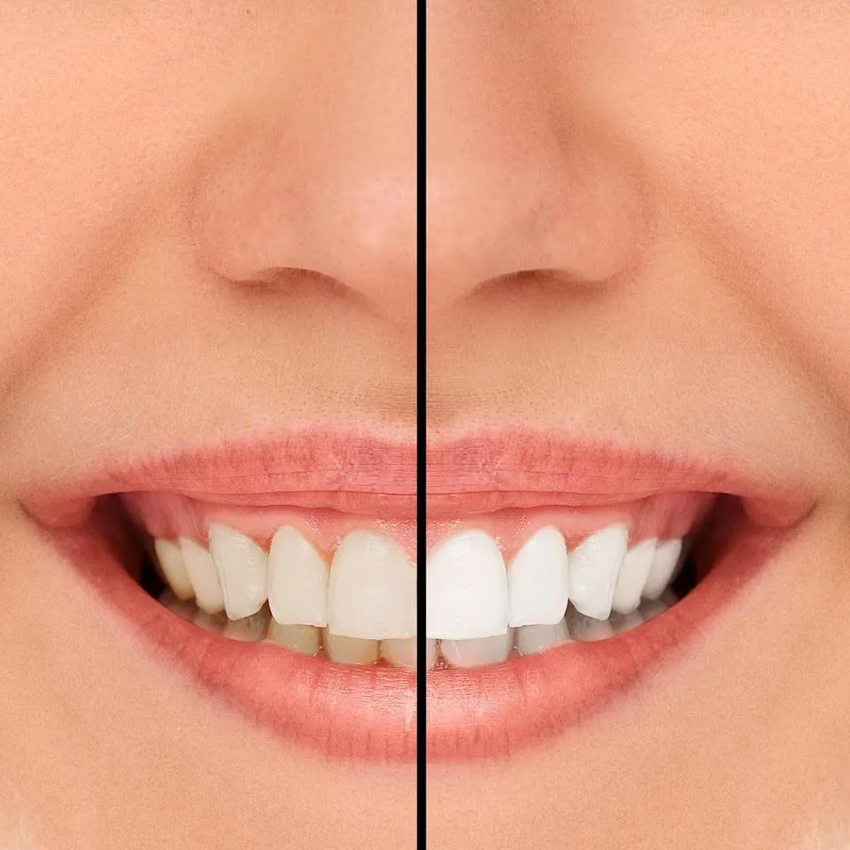 29293 veneer replacement