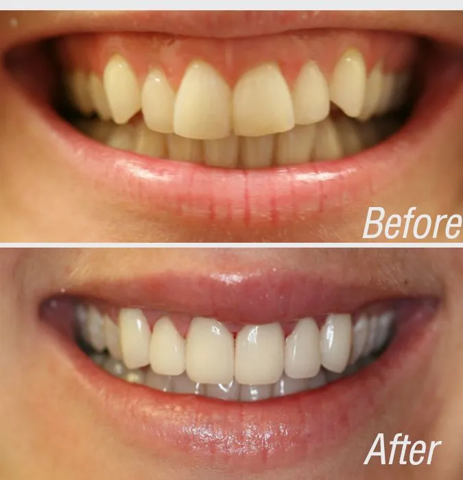 29293 veneers and whitening