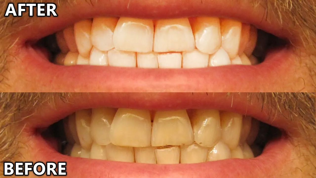 29297 crest whitening strips image5