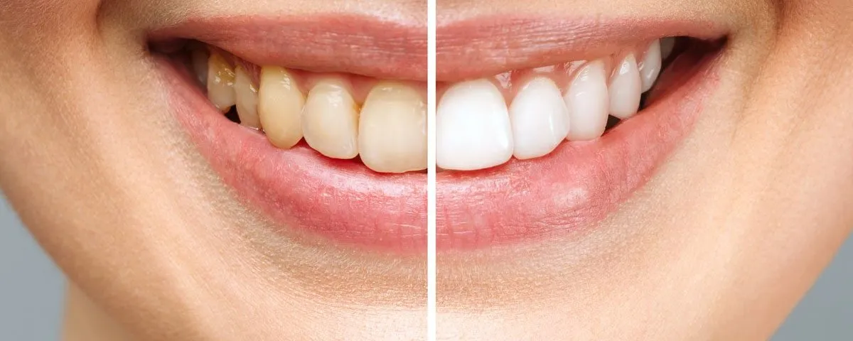 29300 tooth whitening gum burn 2