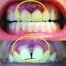 29300 tooth whitening gum burn 3