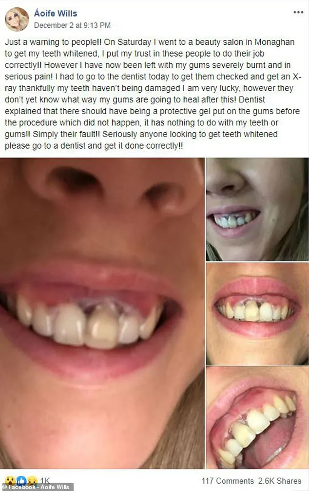 29300 tooth whitening gum burn 4