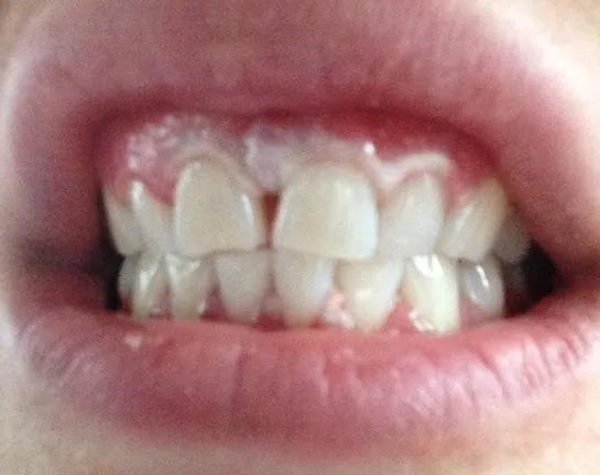 29300 tooth whitening gum burn 6