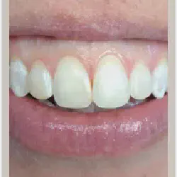 /img/29303-bright-smile-teeth-whitening.webp