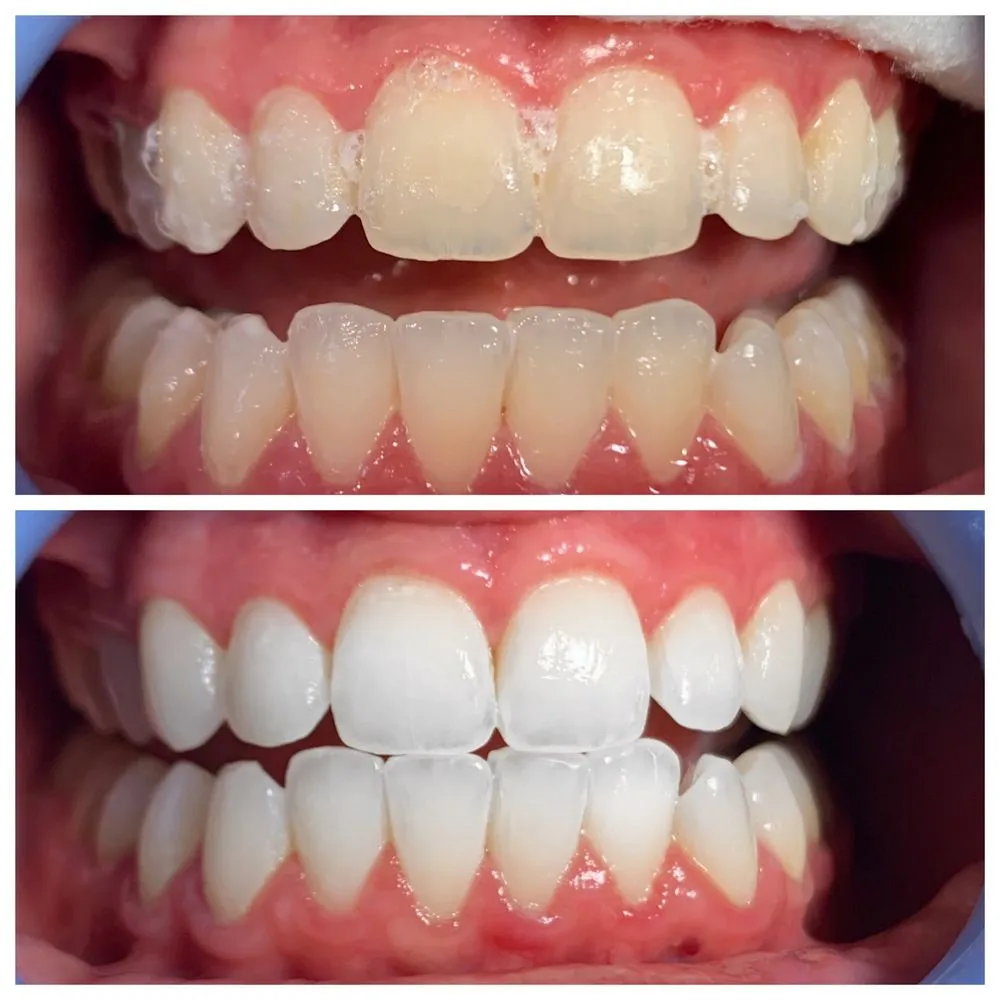 29303 professional teeth whitening santa rosa