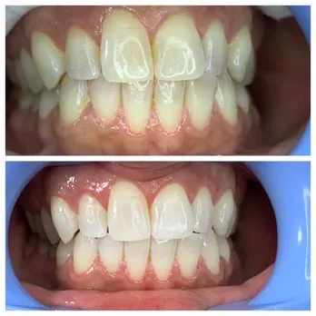 29303 teeth whitening cost
