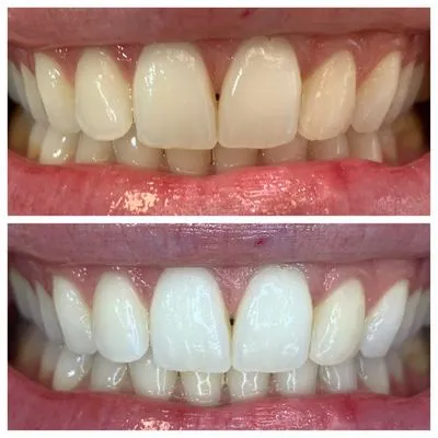 29303 teeth whitening oral hygiene