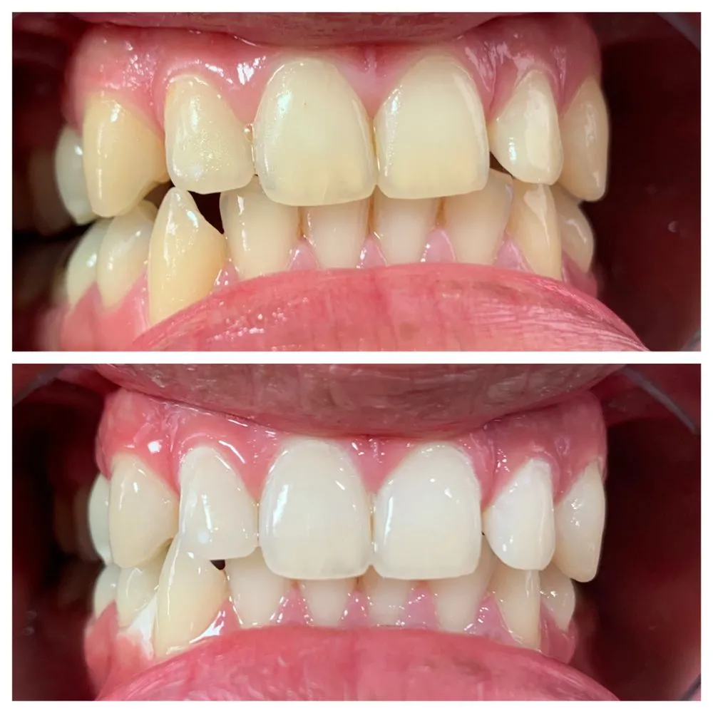 29303 teeth whitening products