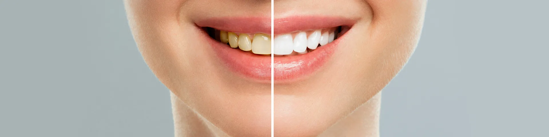 29303 teeth whitening staining foods