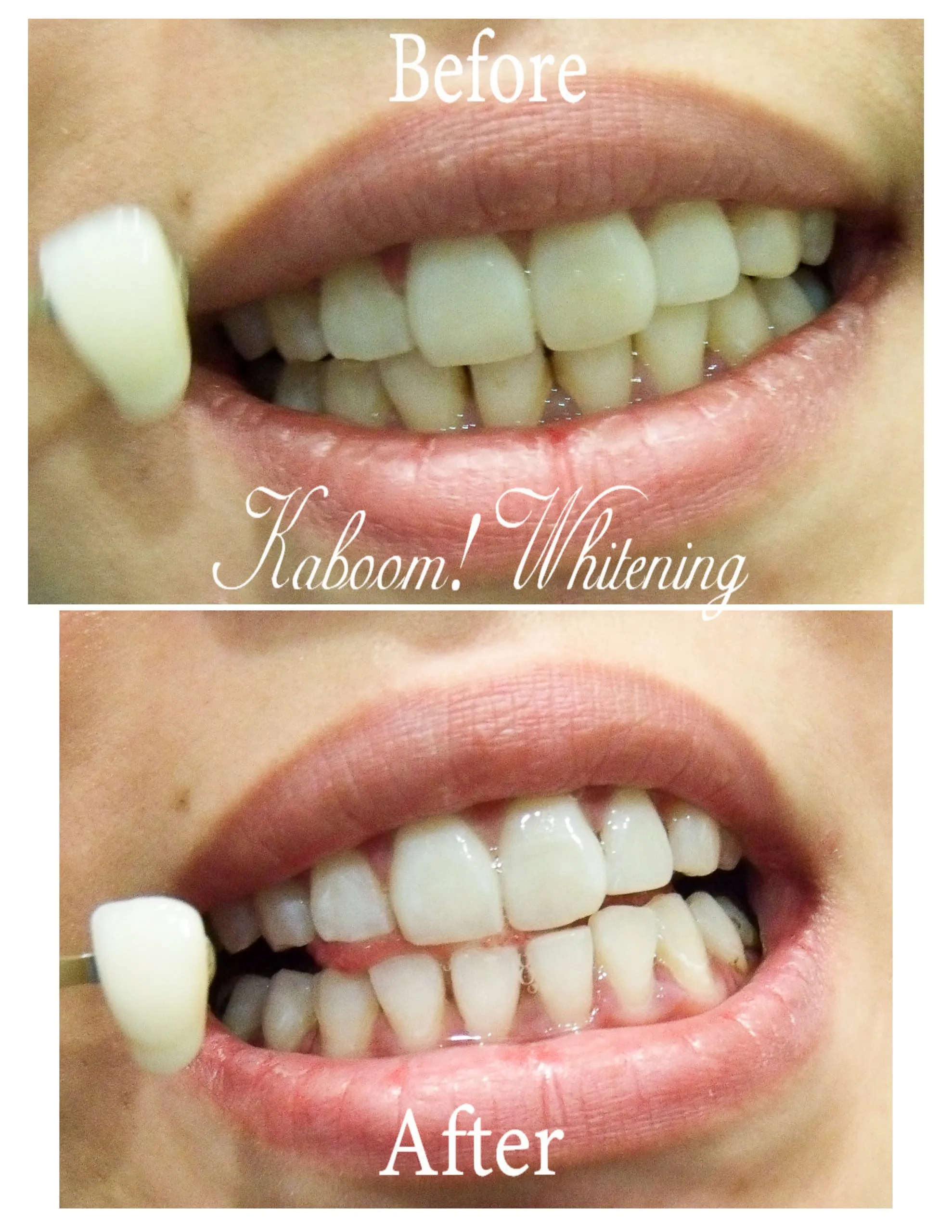 29307 nyc tooth whitening confidence