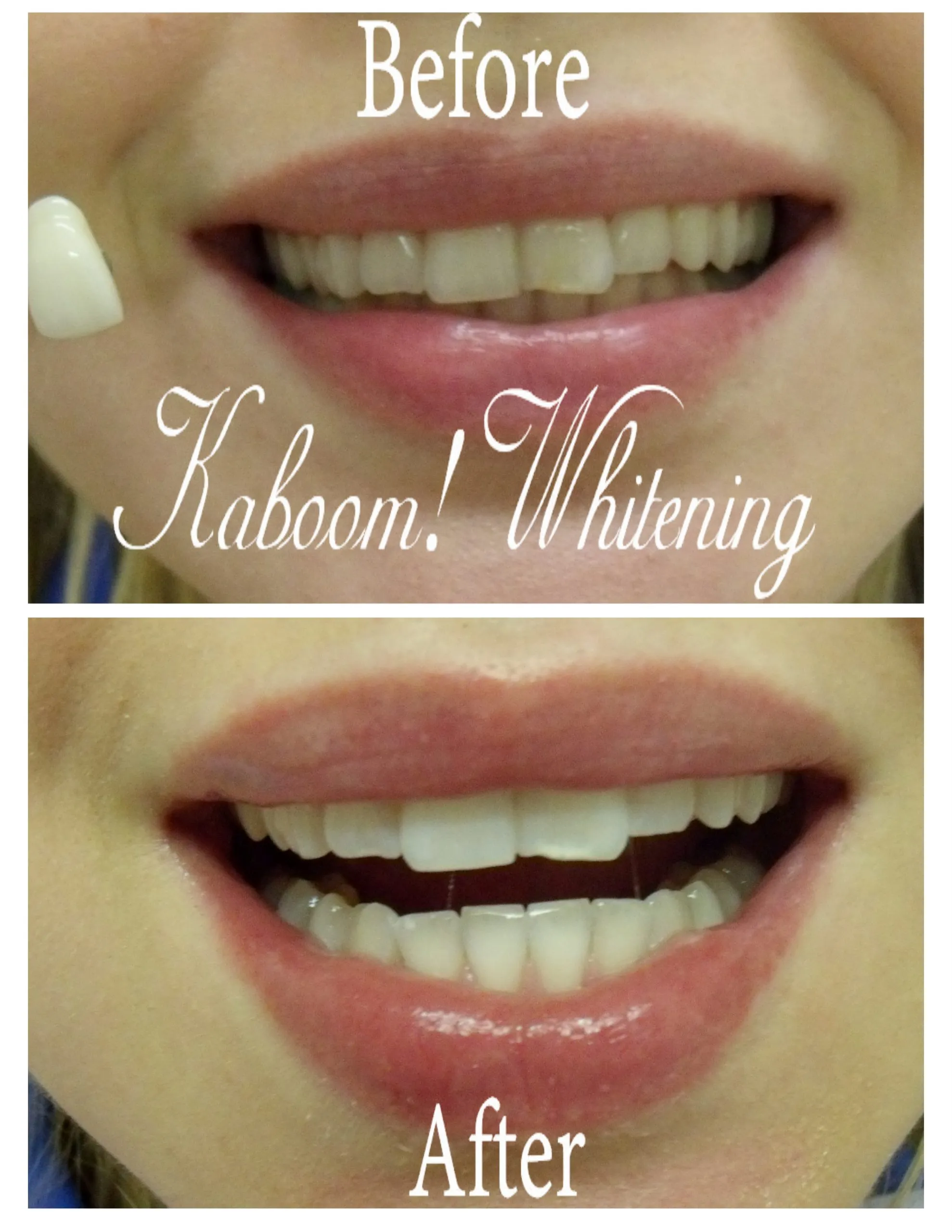 29307 nyc tooth whitening long lasting