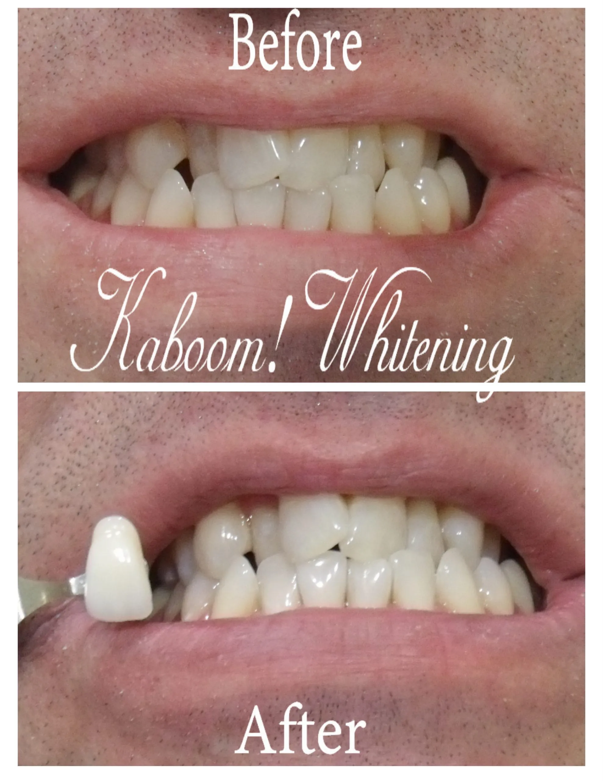 29307 nyc tooth whitening oral health