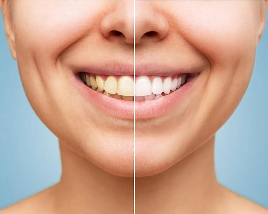 29308 teeth whitening berlin at home kit