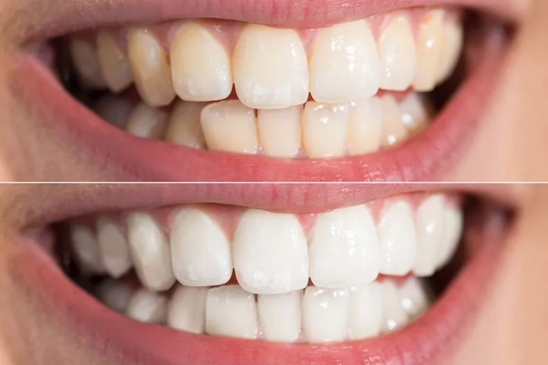 29308 teeth whitening berlin comparison