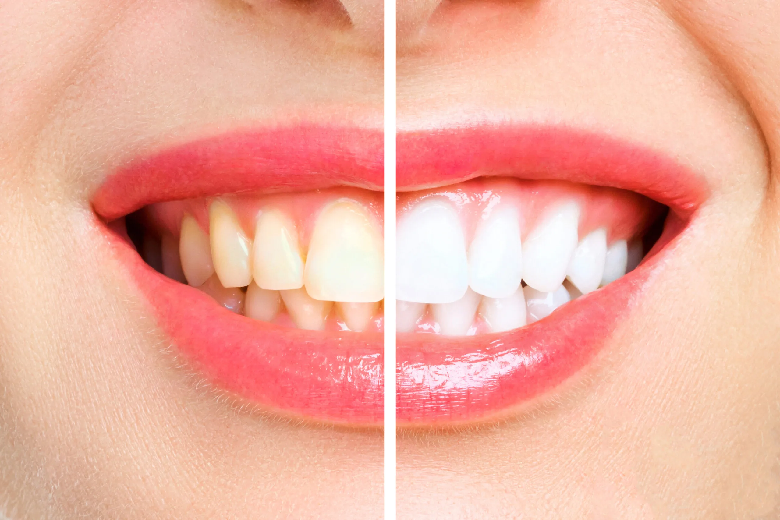 29308 teeth whitening berlin procedure