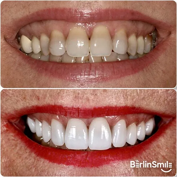 29308 teeth whitening berlin smile