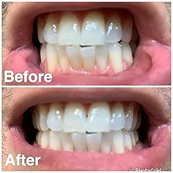 29310 professional teeth whitening