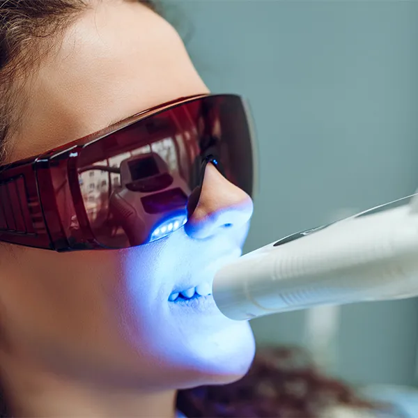 29312 in office teeth whitening